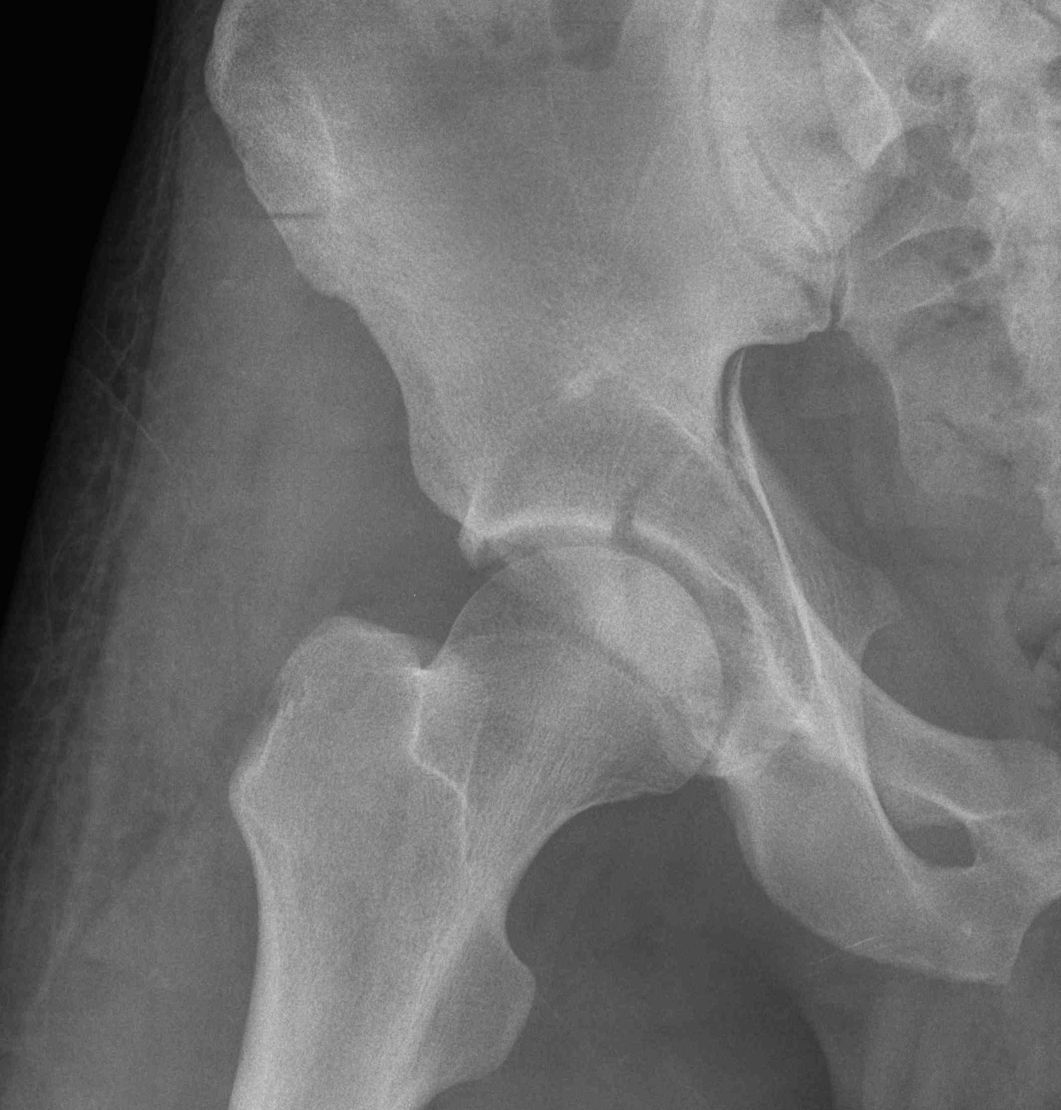 Posterior Column Fracture Xray 3